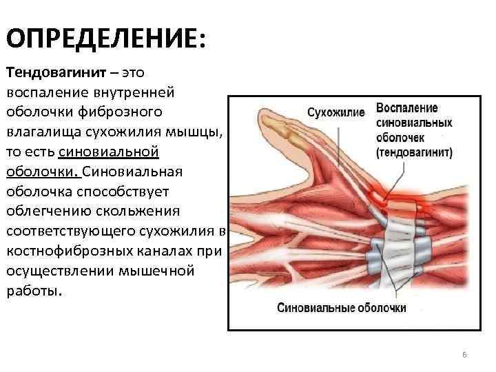 ОПРЕДЕЛЕНИЕ: Тендовагинит – это воспаление внутренней оболочки фиброзного влагалища сухожилия мышцы, то есть синовиальной