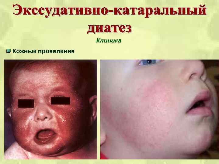 Клиника Кожные проявления 