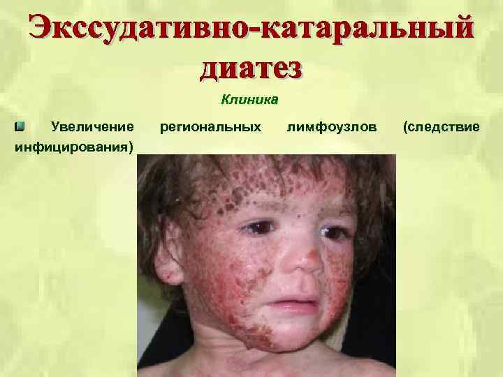 Клиника Увеличение инфицирования) региональных лимфоузлов (следствие 