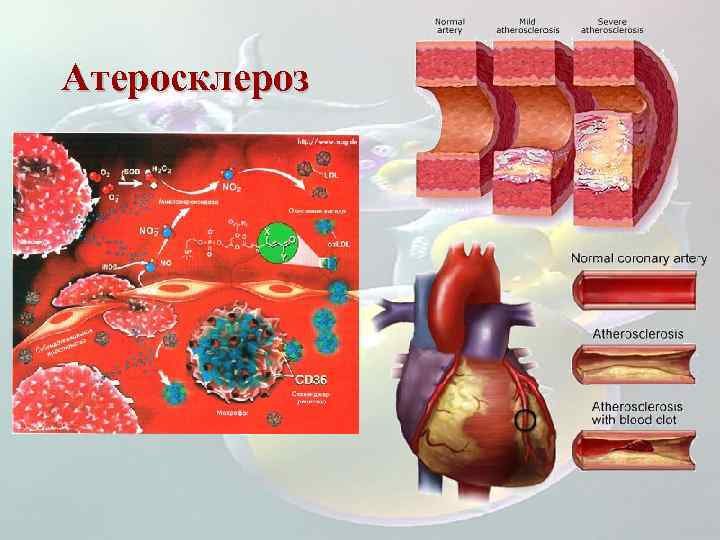 Атеросклероз 