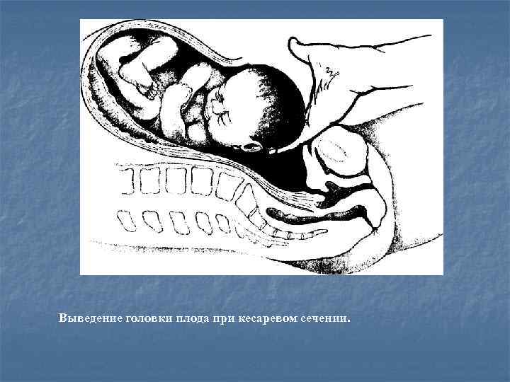 Выведение головки плода при кесаревом сечении. 