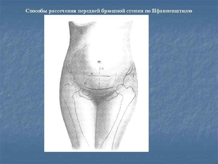 Способы рассечения передней брюшной стенки по Пфанненштилю 