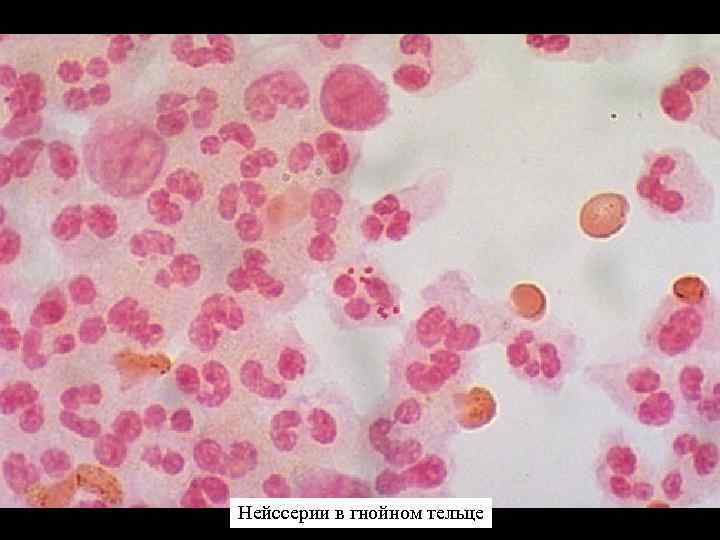 Нейссерии в гнойном тельце 