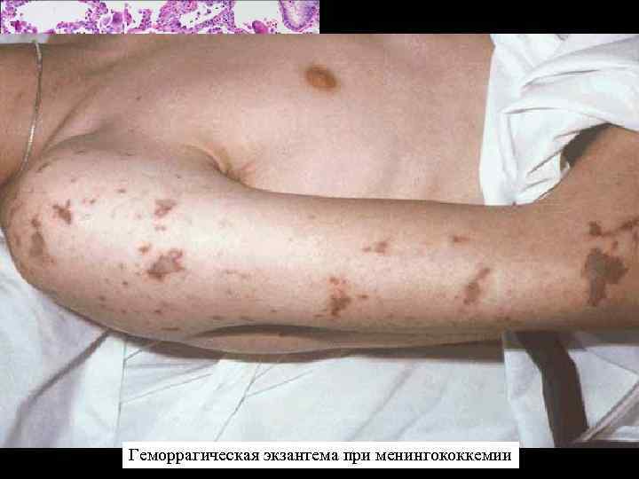 Геморрагическая экзантема при менингококкемии 