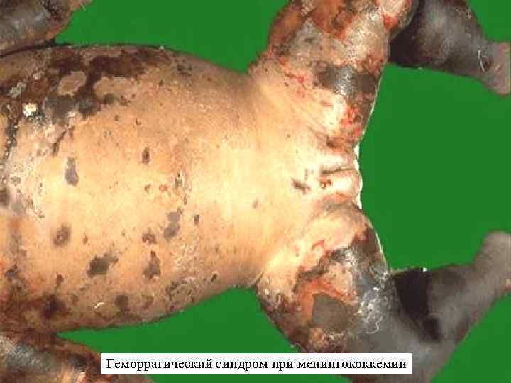 Геморрагический синдром при менингококкемии 