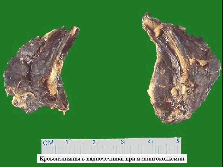 Кровоизлияния в надпочечники при менингококкемии 