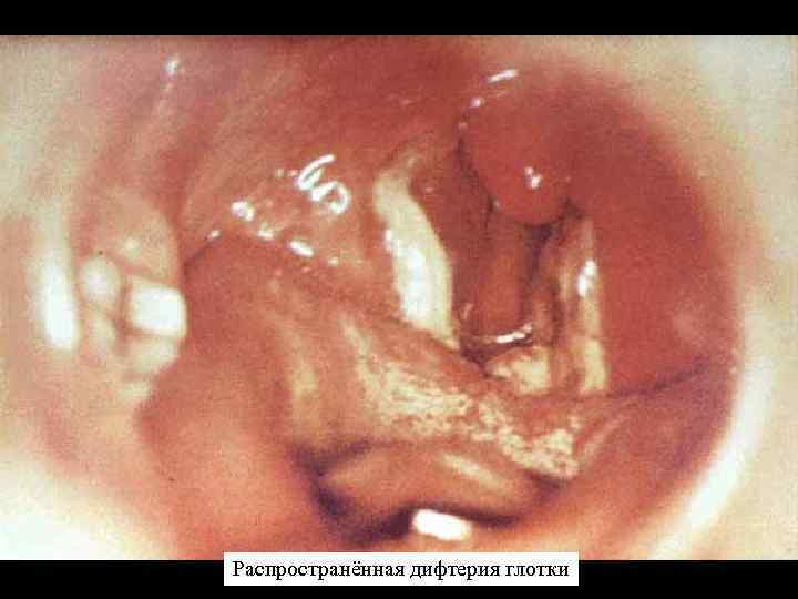 Распространённая дифтерия глотки 