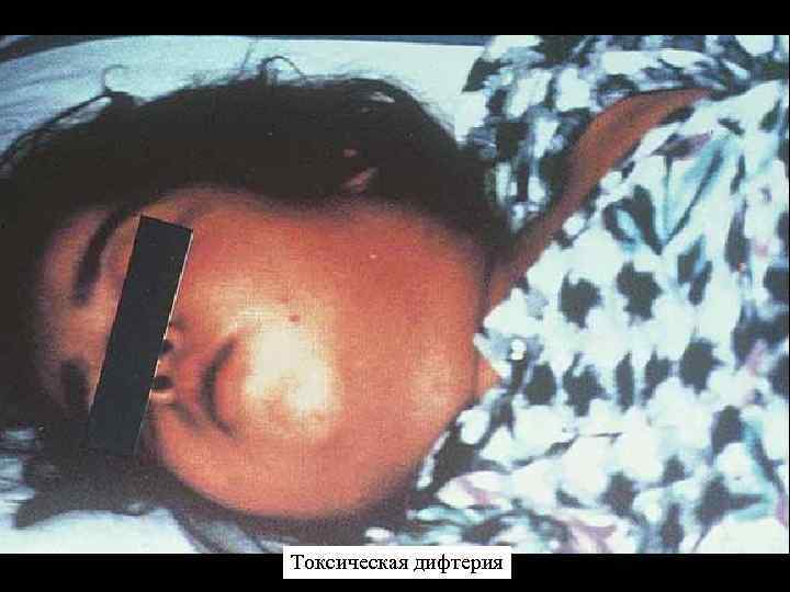 Токсическая дифтерия 