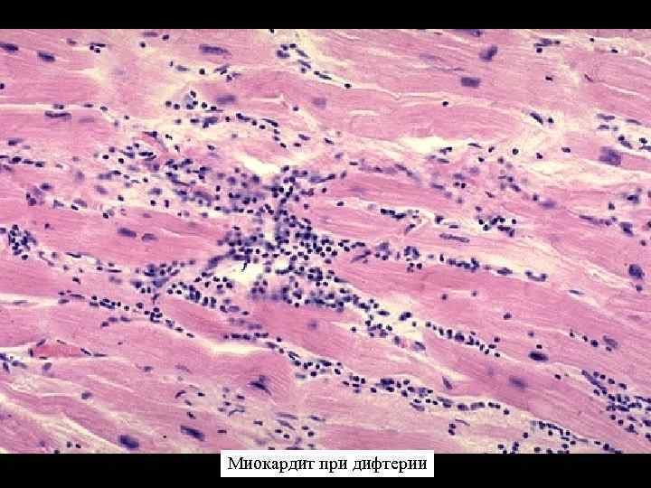 Миокардит при дифтерии 