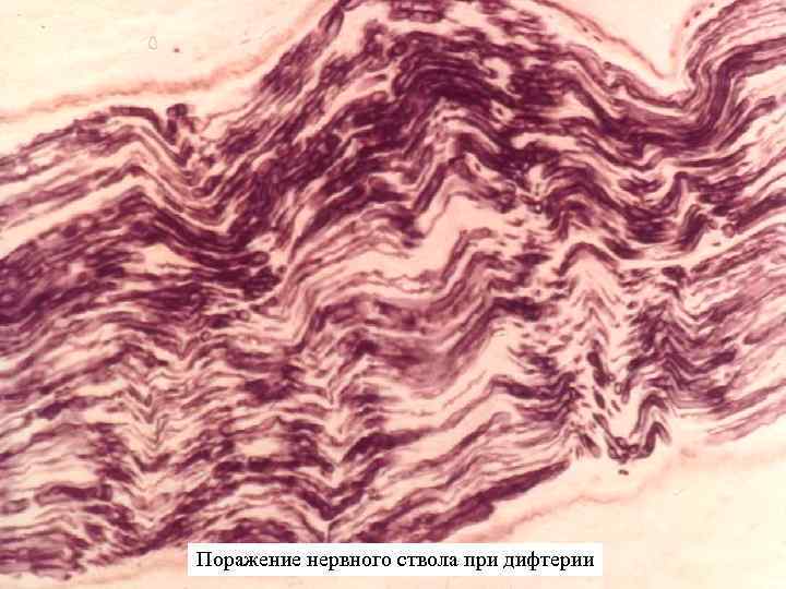 Поражение нервного ствола при дифтерии 