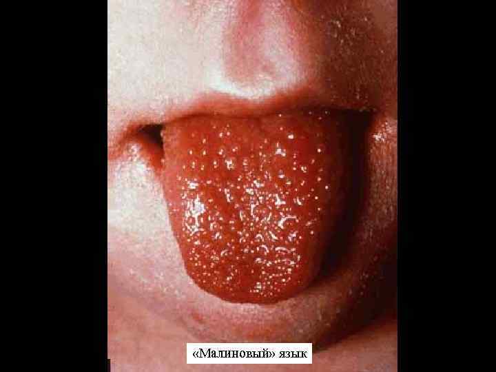  «Малиновый» язык 