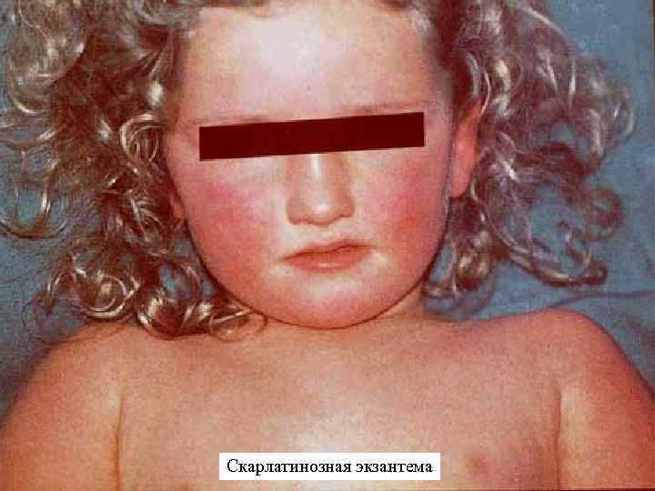 Скарлатинозная экзантема 