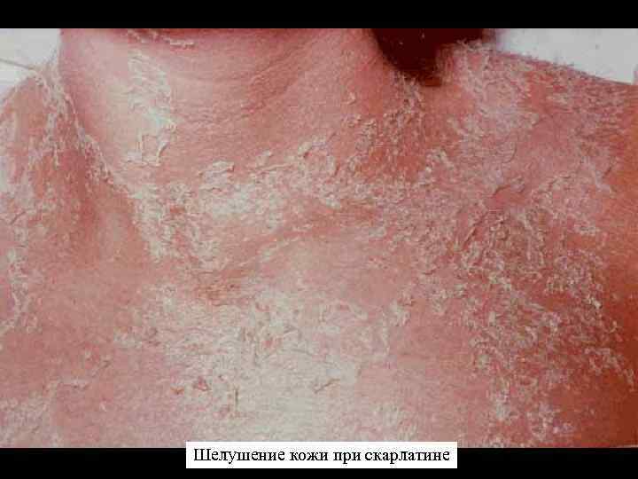 Шелушение кожи при скарлатине 