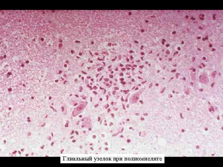 Глиальный узелок при полиомиелите 
