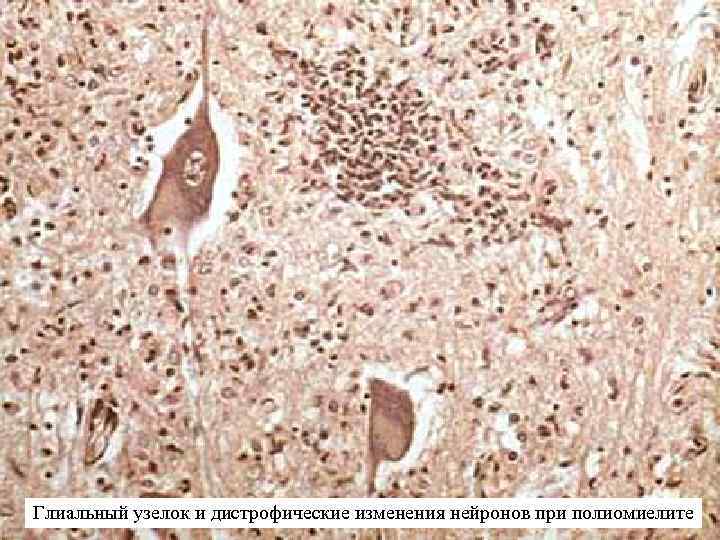 Глиальный узелок и дистрофические изменения нейронов при полиомиелите 