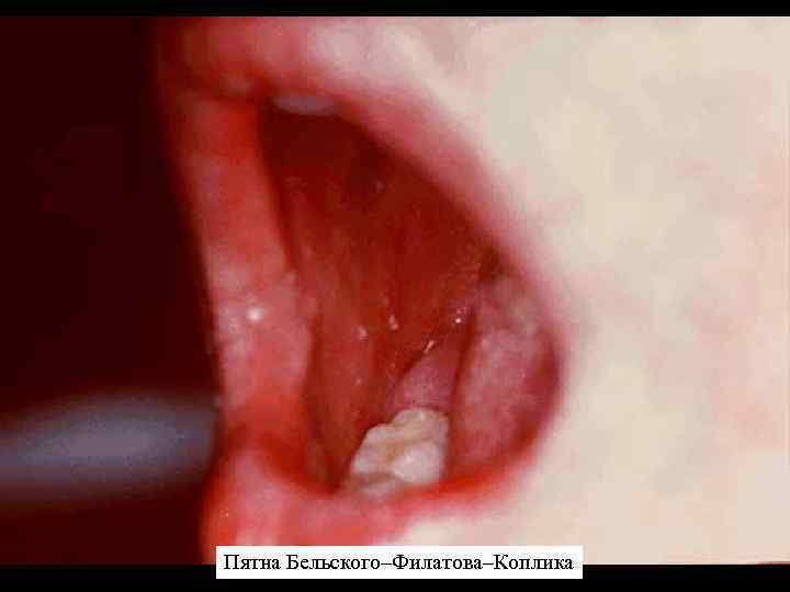 Пятна Бельского–Филатова–Коплика 