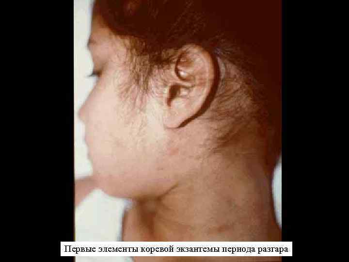 Первые элементы коревой экзантемы периода разгара 
