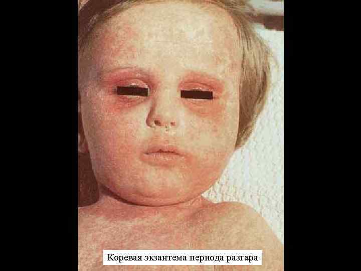 Коревая экзантема периода разгара 
