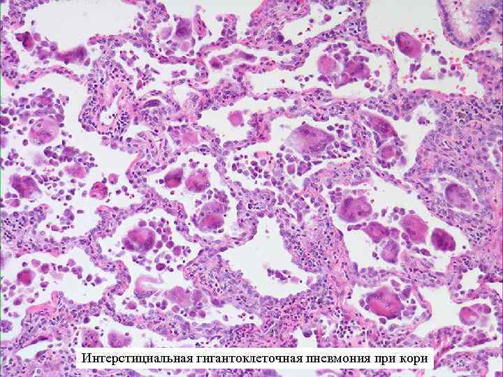 Интерстициальная гигантоклеточная пневмония при кори 