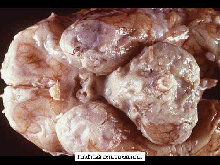 Гнойный лептоменингит 