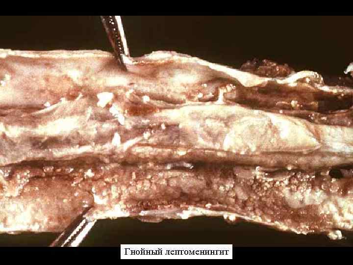 Гнойный лептоменингит 