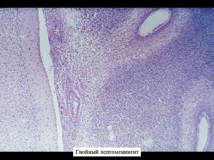 Гнойный лептоменингит 