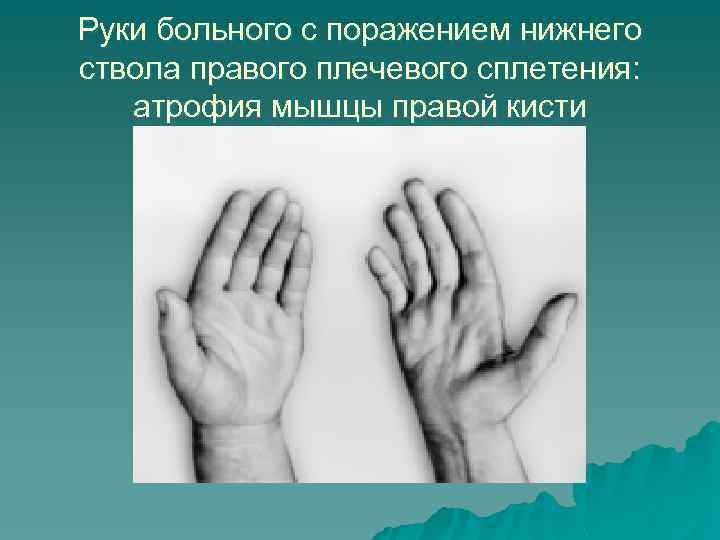 Руки больного с поражением нижнего ствола правого плечевого сплетения: атрофия мышцы правой кисти 