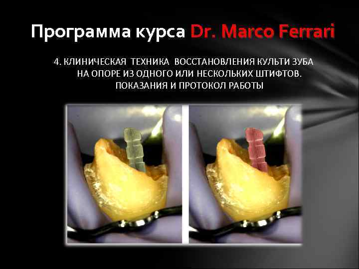 Программа курса Dr. Marco Ferrari 4. КЛИНИЧЕСКАЯ ТЕХНИКА ВОССТАНОВЛЕНИЯ КУЛЬТИ ЗУБА НА ОПОРЕ ИЗ