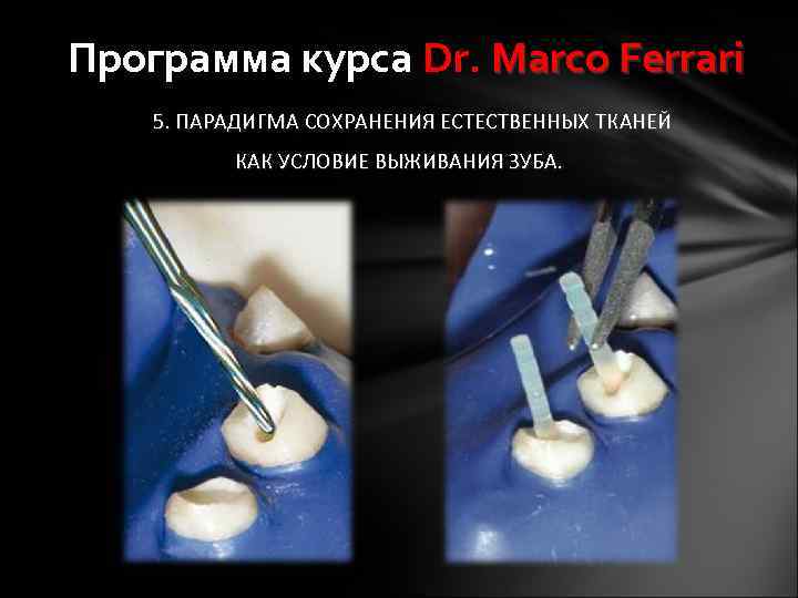 Программа курса Dr. Marco Ferrari 5. ПАРАДИГМА СОХРАНЕНИЯ ЕСТЕСТВЕННЫХ ТКАНЕЙ КАК УСЛОВИЕ ВЫЖИВАНИЯ ЗУБА.