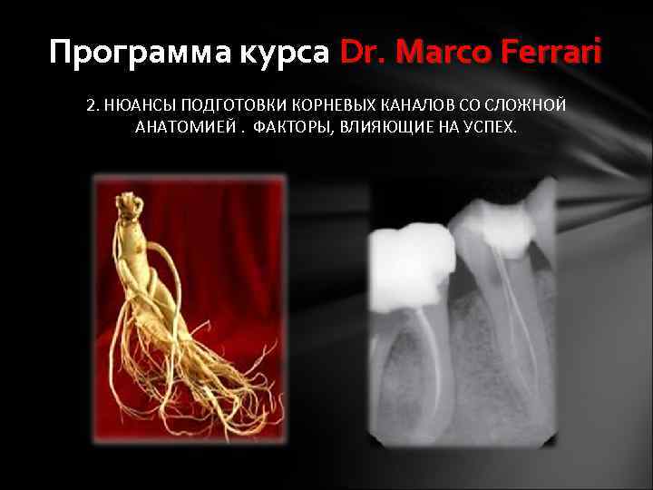 Программа курса Dr. Marco Ferrari 2. НЮАНСЫ ПОДГОТОВКИ КОРНЕВЫХ КАНАЛОВ СО СЛОЖНОЙ АНАТОМИЕЙ. ФАКТОРЫ,