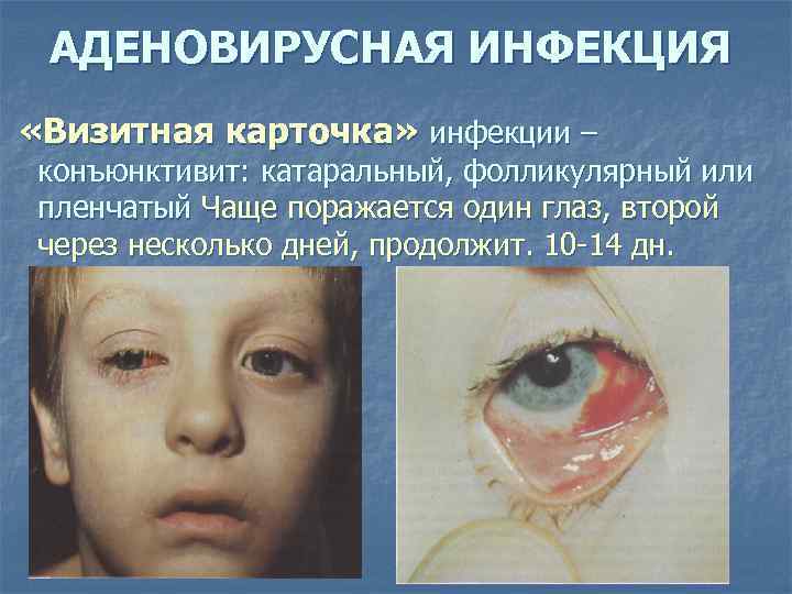 АДЕНОВИРУСНАЯ ИНФЕКЦИЯ «Визитная карточка» инфекции – конъюнктивит: катаральный, фолликулярный или пленчатый Чаще поражается один