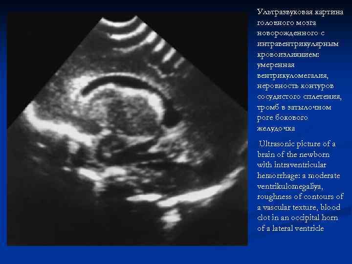 Ультразвуковая картина головного мозга новорожденного с интравентрикулярным кровоизлиянием: умеренная вентрикуломегалия, неровность контуров сосудистого сплетения,