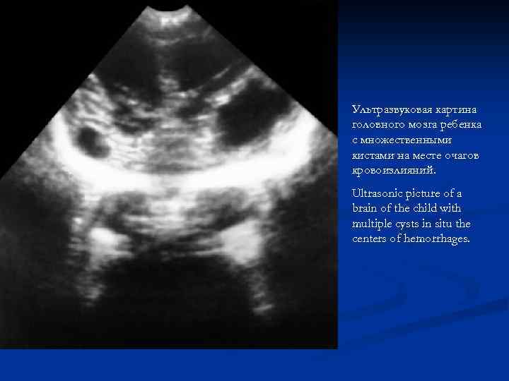 Ультразвуковая картина головного мозга ребенка с множественными кистами на месте очагов кровоизлияний. Ultrasonic picture