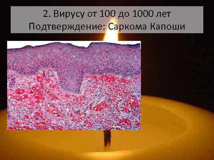 2. Вирусу от 100 до 1000 лет Подтверждение: Саркома Капоши 