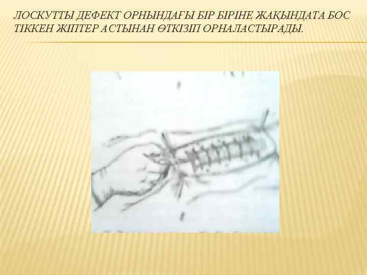 ЛОСКУТТЫ ДЕФЕКТ ОРНЫНДАҒЫ БІРІНЕ ЖАҚЫНДАТА БОС ТІККЕН ЖІПТЕР АСТЫНАН ӨТКІЗІП ОРНАЛАСТЫРАДЫ. 