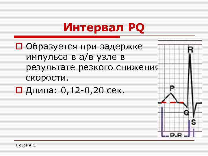 Интервал PQ o Образуется при задержке импульса в а/в узле в результате резкого снижения