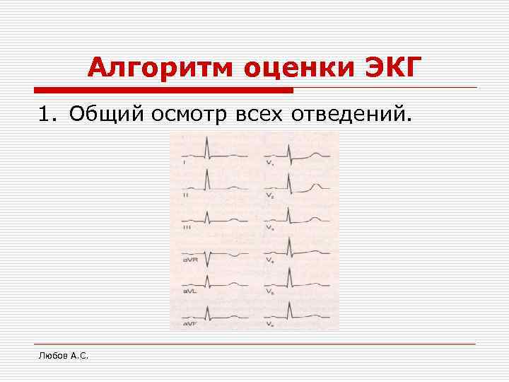 Алгоритм оценки ЭКГ 1. Общий осмотр всех отведений. Любов А. С. 