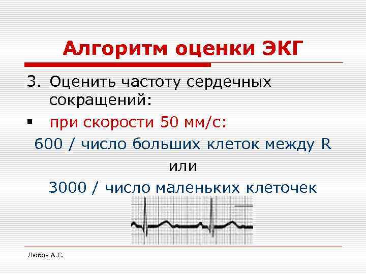 Алгоритм оценки ЭКГ 3. Оценить частоту сердечных сокращений: § при скорости 50 мм/с: 600