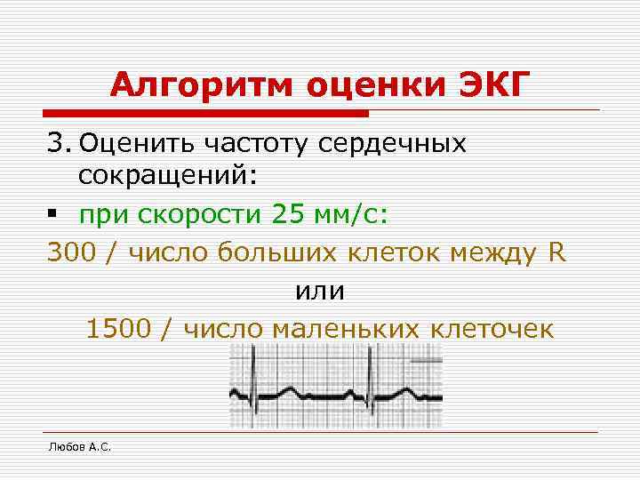 Алгоритм оценки ЭКГ 3. Оценить частоту сердечных сокращений: § при скорости 25 мм/с: 300