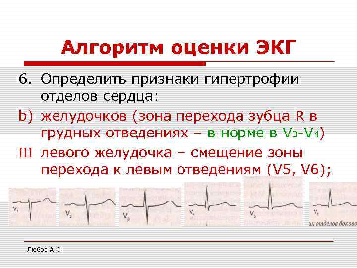 Алгоритм оценки ЭКГ 6. Определить признаки гипертрофии отделов сердца: b) желудочков (зона перехода зубца