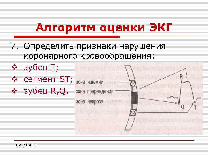 Алгоритм оценки ЭКГ 7. Определить признаки нарушения коронарного кровообращения: v зубец Т; v сегмент