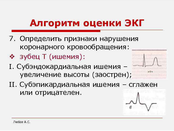 Алгоритм оценки ЭКГ 7. Определить признаки нарушения коронарного кровообращения: v зубец Т (ишемия): I.