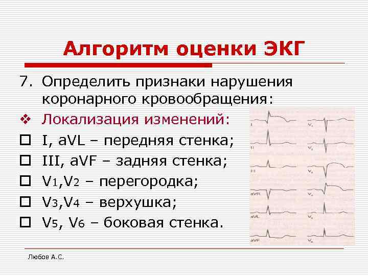 Алгоритм оценки ЭКГ 7. Определить признаки нарушения коронарного кровообращения: v Локализация изменений: o I,