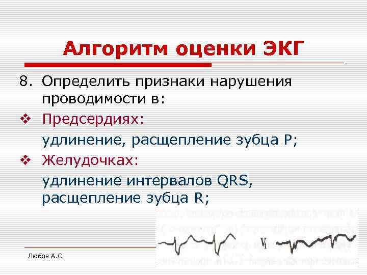 Алгоритм оценки ЭКГ 8. Определить признаки нарушения проводимости в: v Предсердиях: удлинение, расщепление зубца