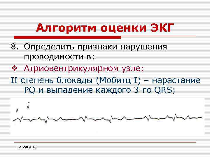 Алгоритм оценки ЭКГ 8. Определить признаки нарушения проводимости в: v Атриовентрикулярном узле: II степень