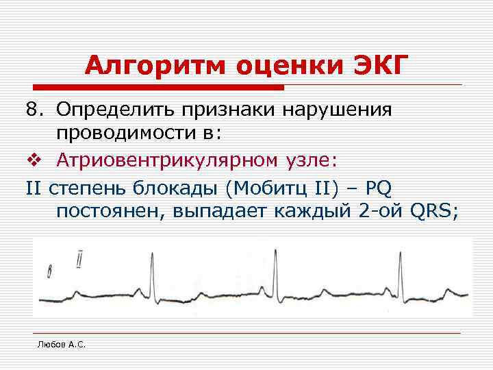 Алгоритм оценки ЭКГ 8. Определить признаки нарушения проводимости в: v Атриовентрикулярном узле: II степень