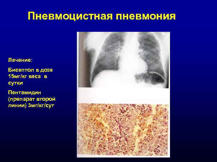Пневмоцистная пневмония Лечение: Бисептол в дозе 15 мг/кг веса в сутки Пентамидин (препарат второй