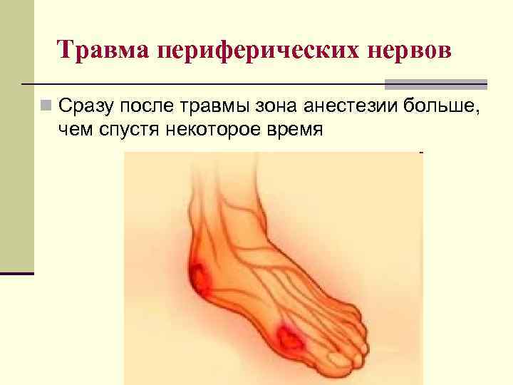 Травма периферических нервов n Сразу после травмы зона анестезии больше, чем спустя некоторое время