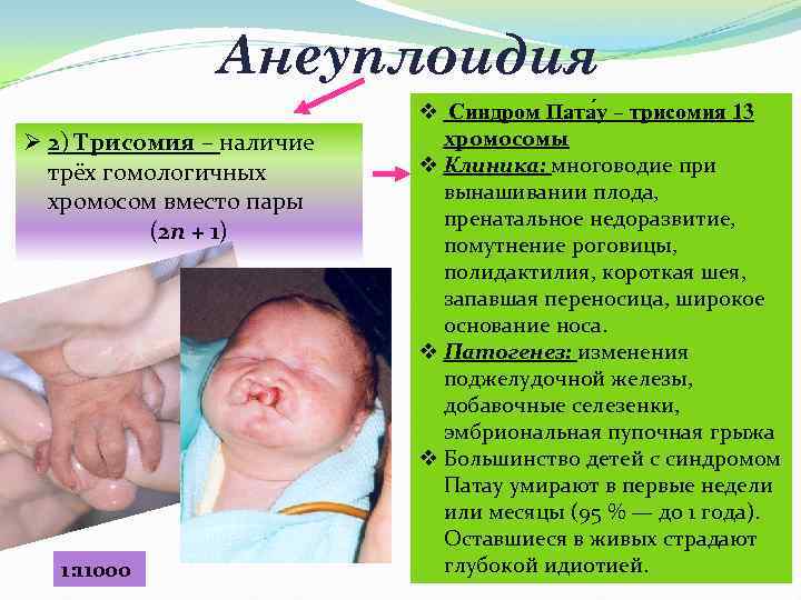  Анеуплоидия v Синдром Пата у – трисомия 13 Ø 2) Трисомия – наличие