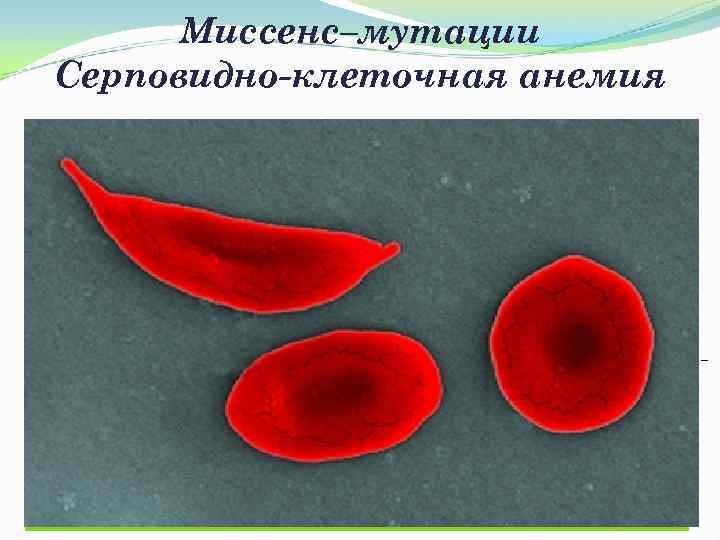  Миссенс–мутации Серповидно-клеточная анемия Две a-цепи (a-цепь закодирована в 16 - При гипоксии (недостатке